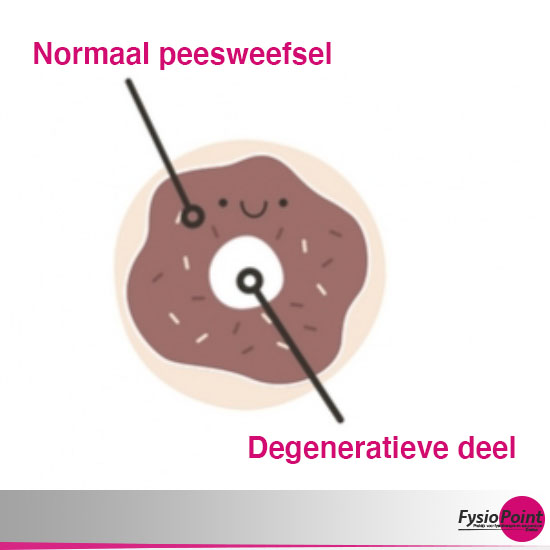 FysioPoint Druten EPTE therapie